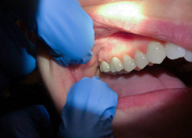 Best Emergency Tooth Extraction in Ossian, IN